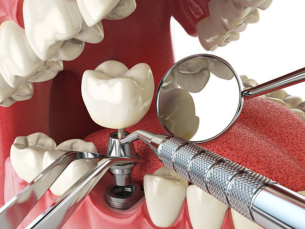 Best Knocked-Out Tooth (Avulsed Tooth) Treatment in Urania, LA